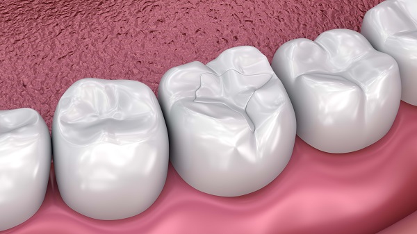 How Does Dental Sealant Treatment Work? 1 dental sealant Dunwoody, GA
